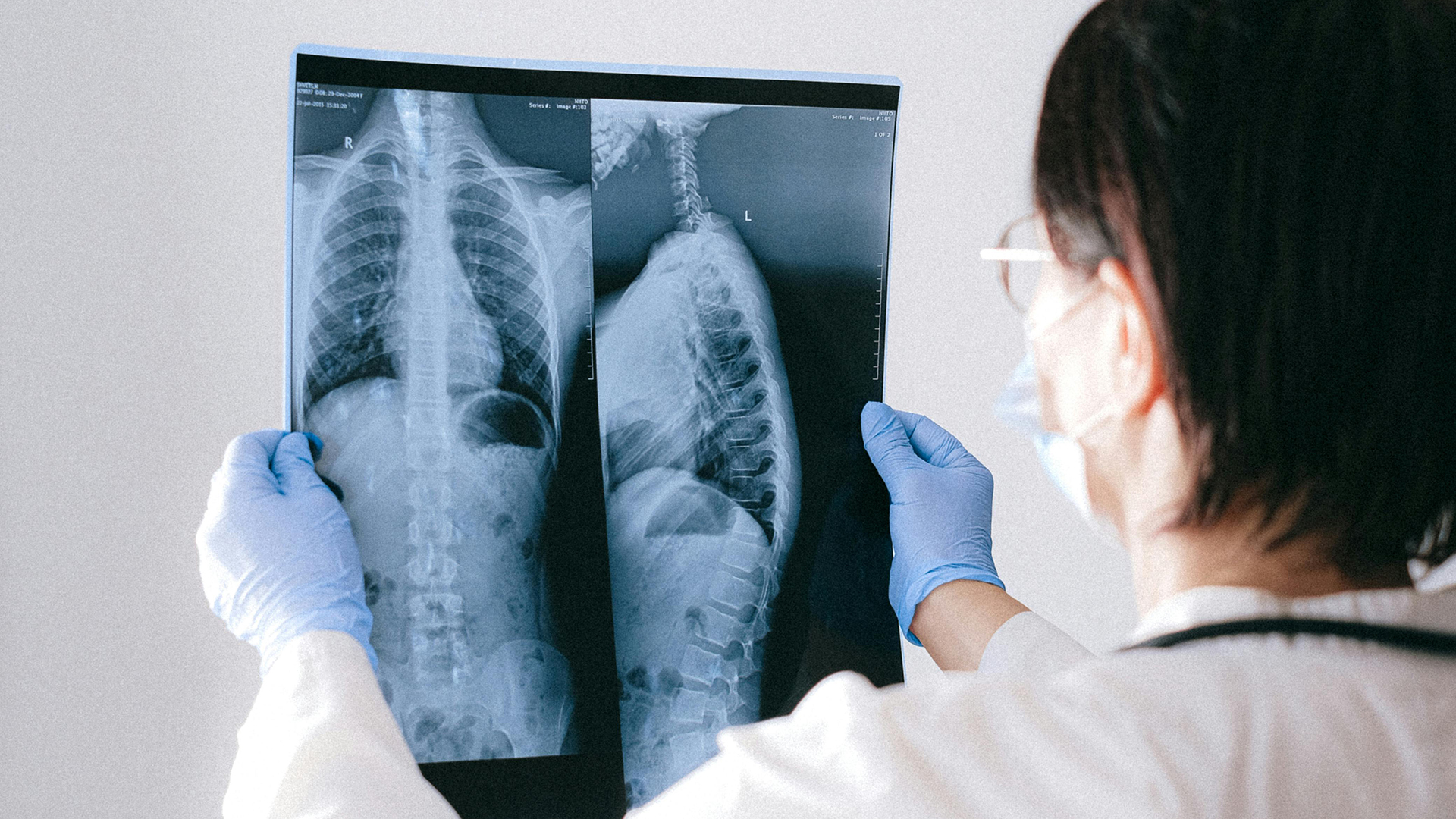 Doctor holding up a chest X-Ray.