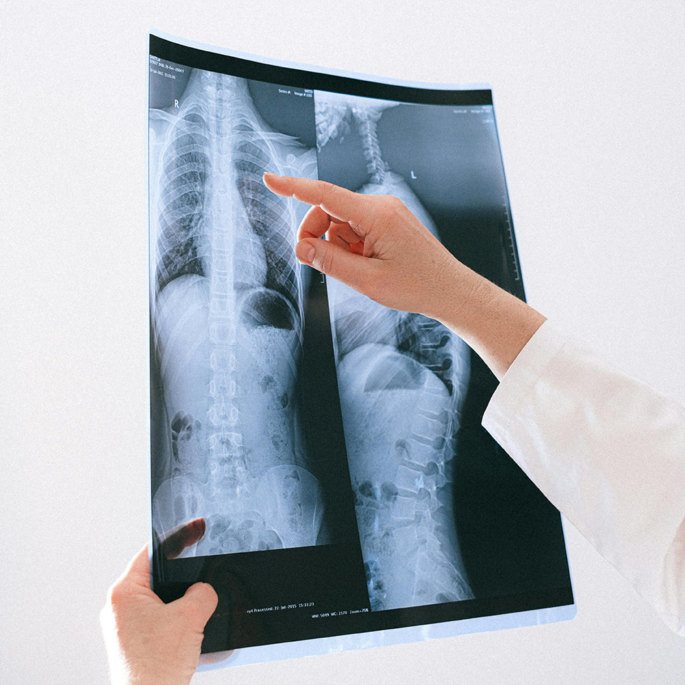 Chest X-ray showing lungs and ribcage used in occupational lung health screening.