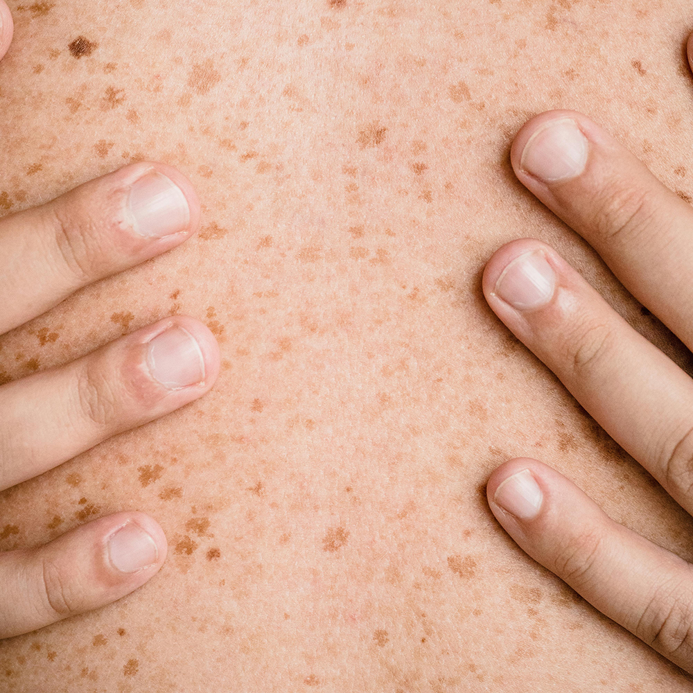 Freckled skin on a person's back.